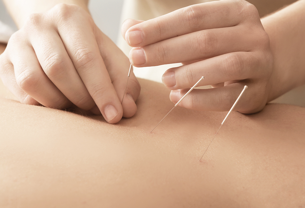 Acupuncture-Central Chiropractic & Wellness