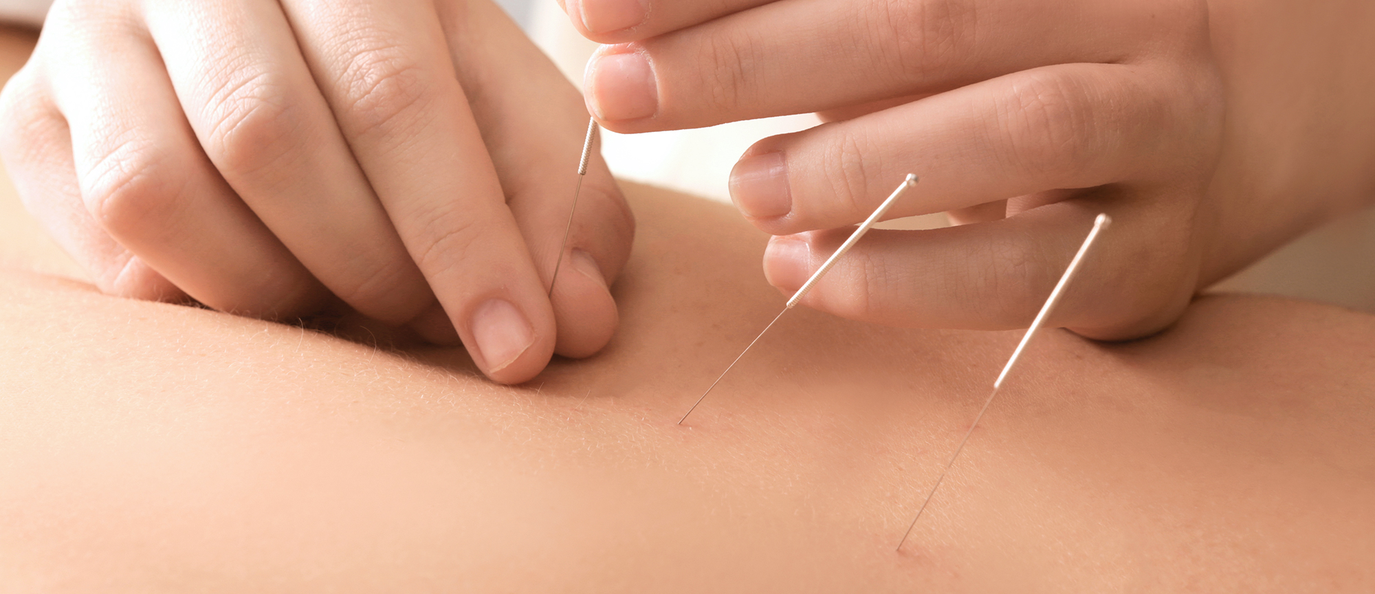 Acupuncture-Central Chiropractic & Wellness